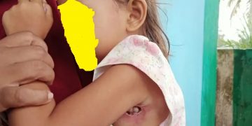 Kisah Pilu Bocah Penderita Infeksi, Tak Bisa Berobat karena Himpitan Ekonomi