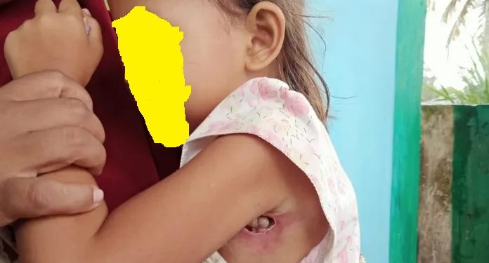 Kisah Pilu Bocah Penderita Infeksi, Tak Bisa Berobat karena Himpitan Ekonomi